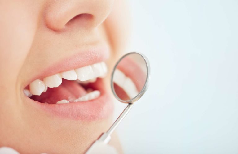 Clareamento dental: mitos e fatos