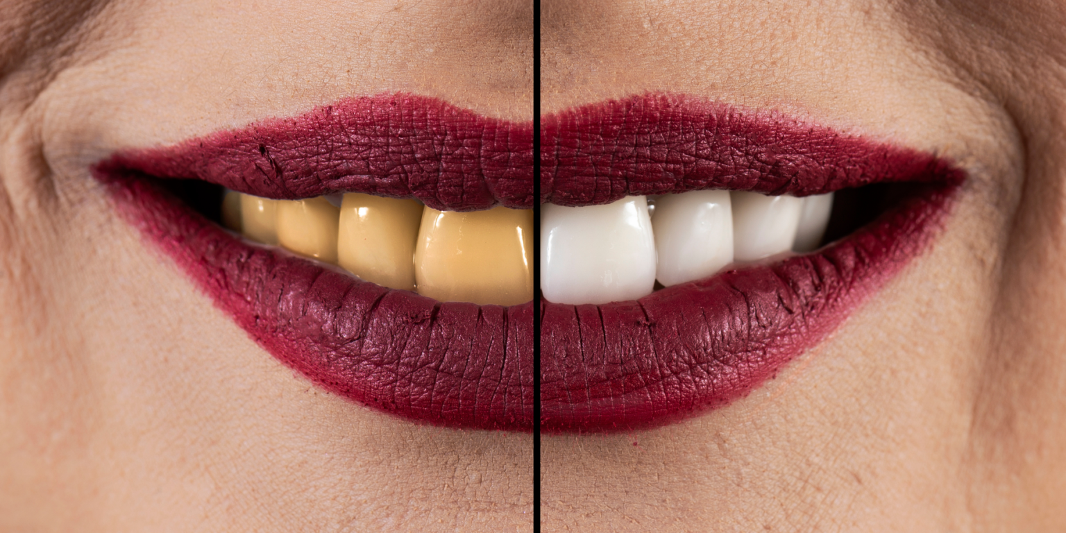 Cuidados Antes E Depois Do Clareamento Dental